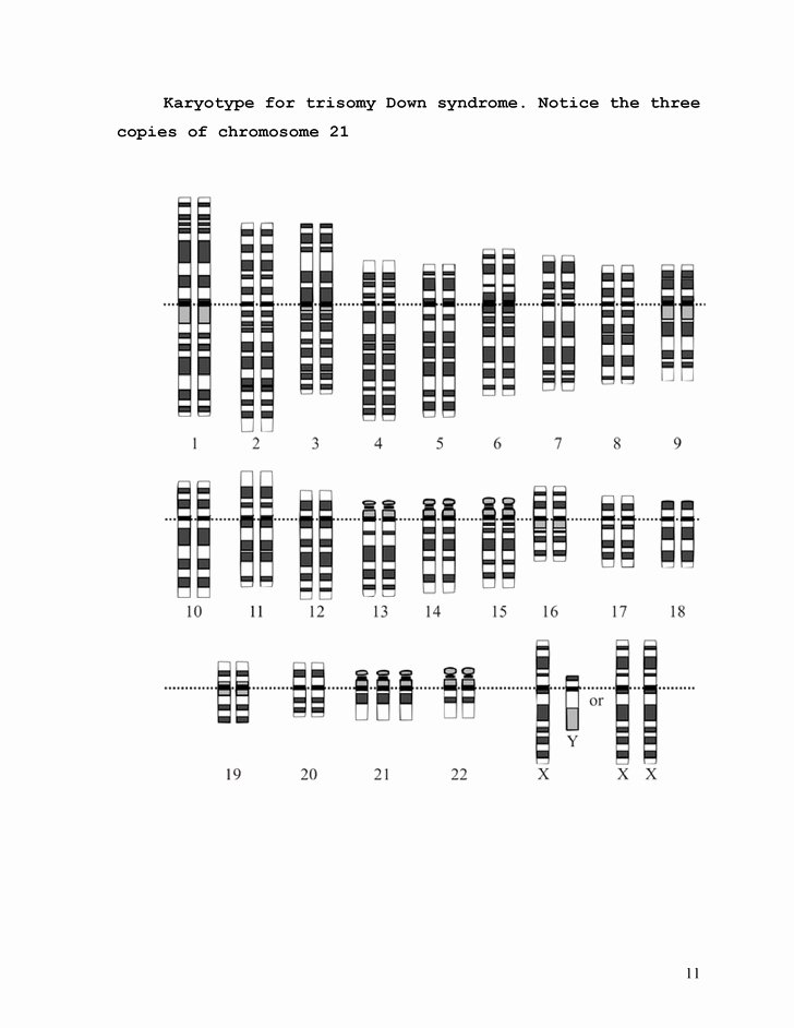 Essays On Down Syndrome Best Of Down Syndrome Research Paper Drodgereport923 Web Fc2