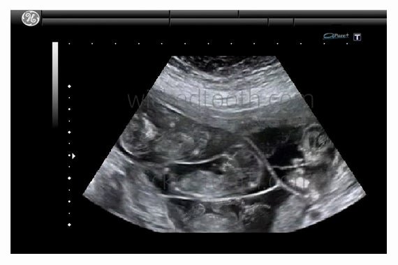 Gag order Sample Awesome Quadruplets Ultrasoundfake Ultrasoundprankgag T