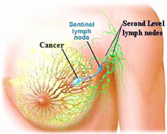 Informative Speech On Breast Cancer Beautiful Lymphedema Wheelchair Usage Health Conditions